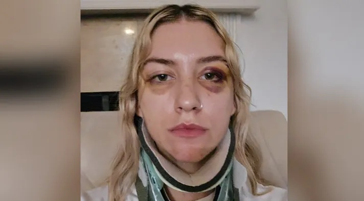Leigh-Anne McKenzie after assault, with bruised eye and neck brace visible